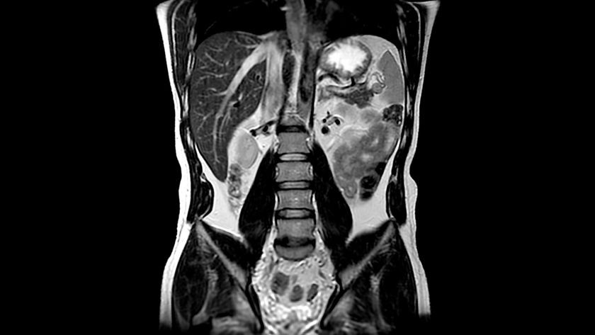 Abdominal MRI, showing fluid, fat and air